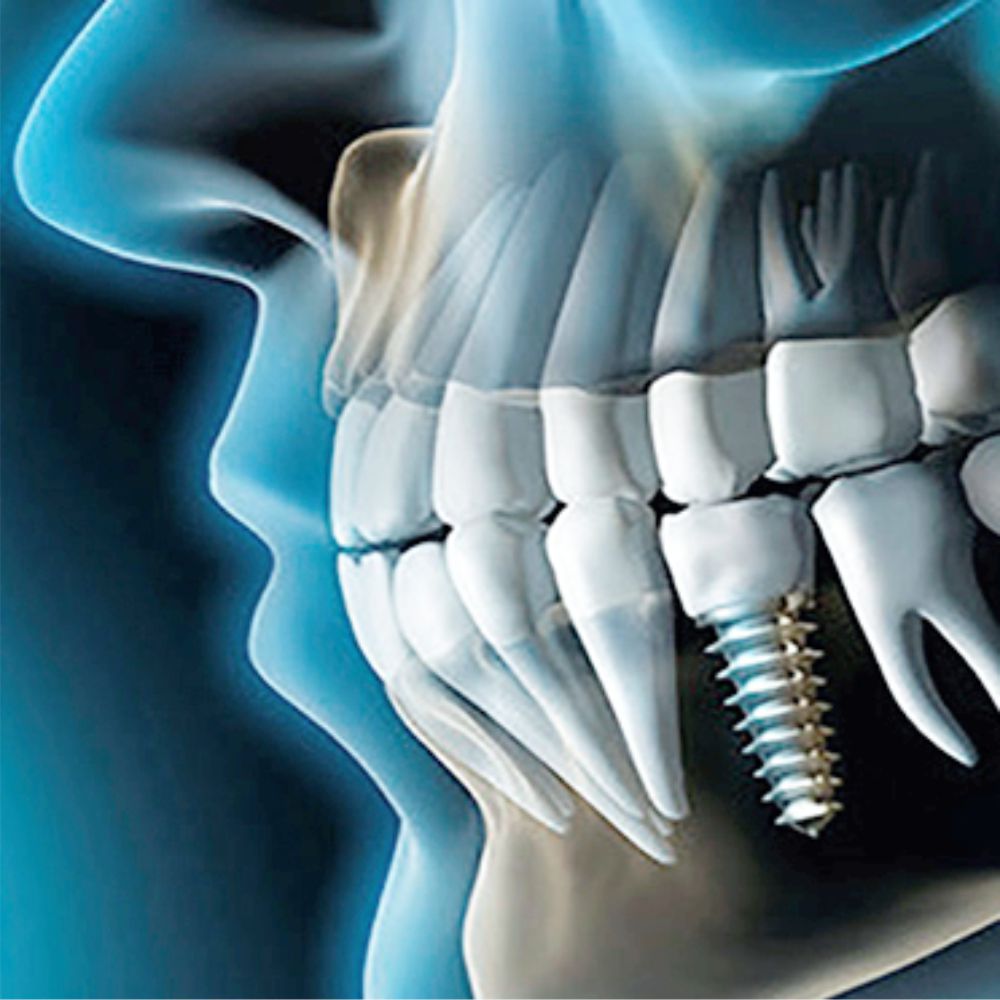 implantologia dentale Augusta Siracusa