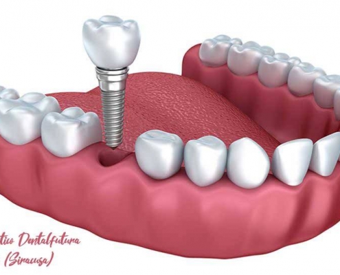 dentista_augusta_implantologia