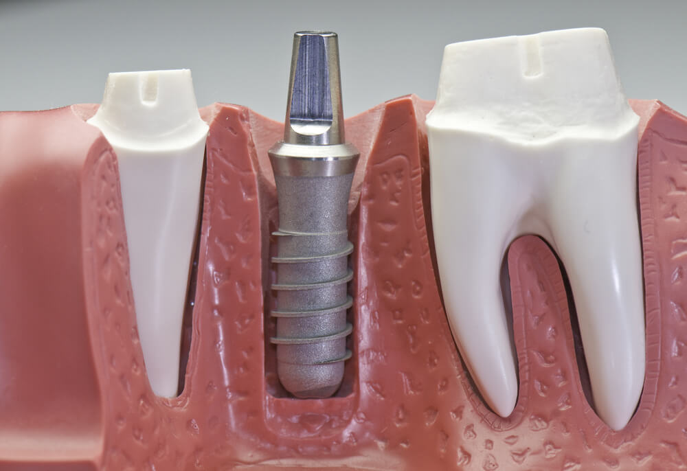 implantologia_dentale