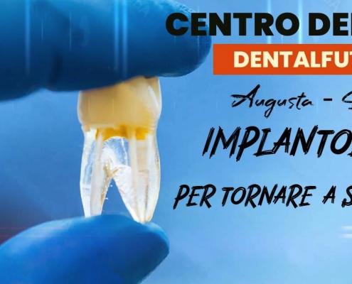 Impianto dentale - Implantologia - Centro Dentistico ad Augusta - Siracusa - Sicilia