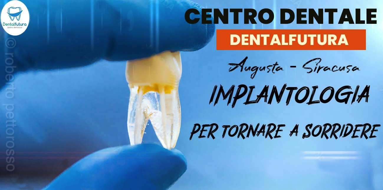 Impianto dentale - Implantologia - Centro Dentistico ad Augusta - Siracusa - Sicilia